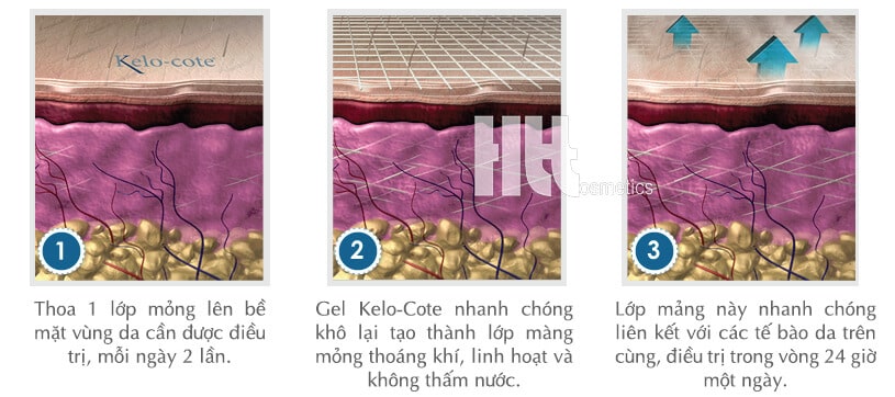 Kem trị sẹo Kelo-Cote làm liền sẹo nhanh - Hoa Thiên Thảo