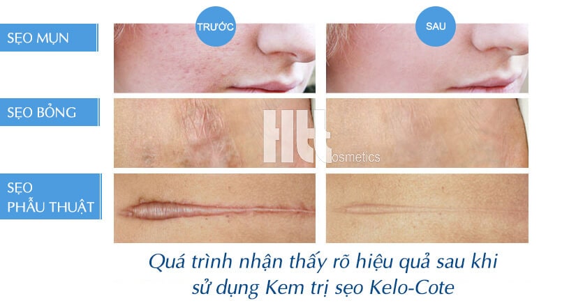 Kem trị sẹo Kelo-Cote làm liền sẹo nhanh - Hoa Thiên Thảo