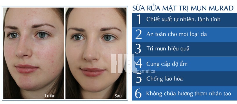 Sữa rửa mặt Murad trị mụn chống lão hóa Time Release Acne Cleanser - Hoa Thiên Thảo