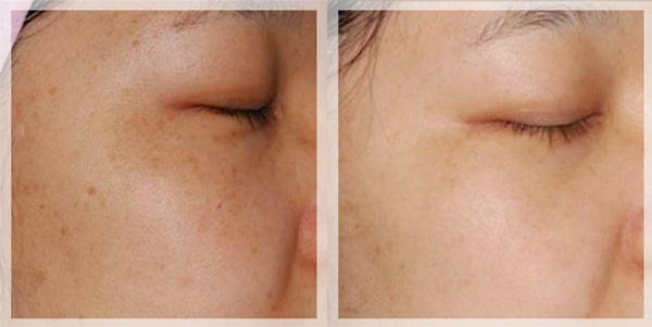 Trước và sau khi sử dụng Tinh chất trắng da Mesoestetic Ultimate W+ Whitening Essence