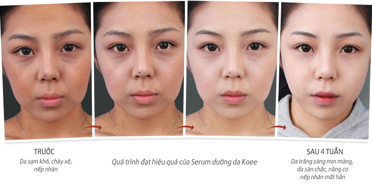 Kết quả sau khi sử dụng viên serum chống lão hóa dưỡng trắng da Koee thường xuyên
